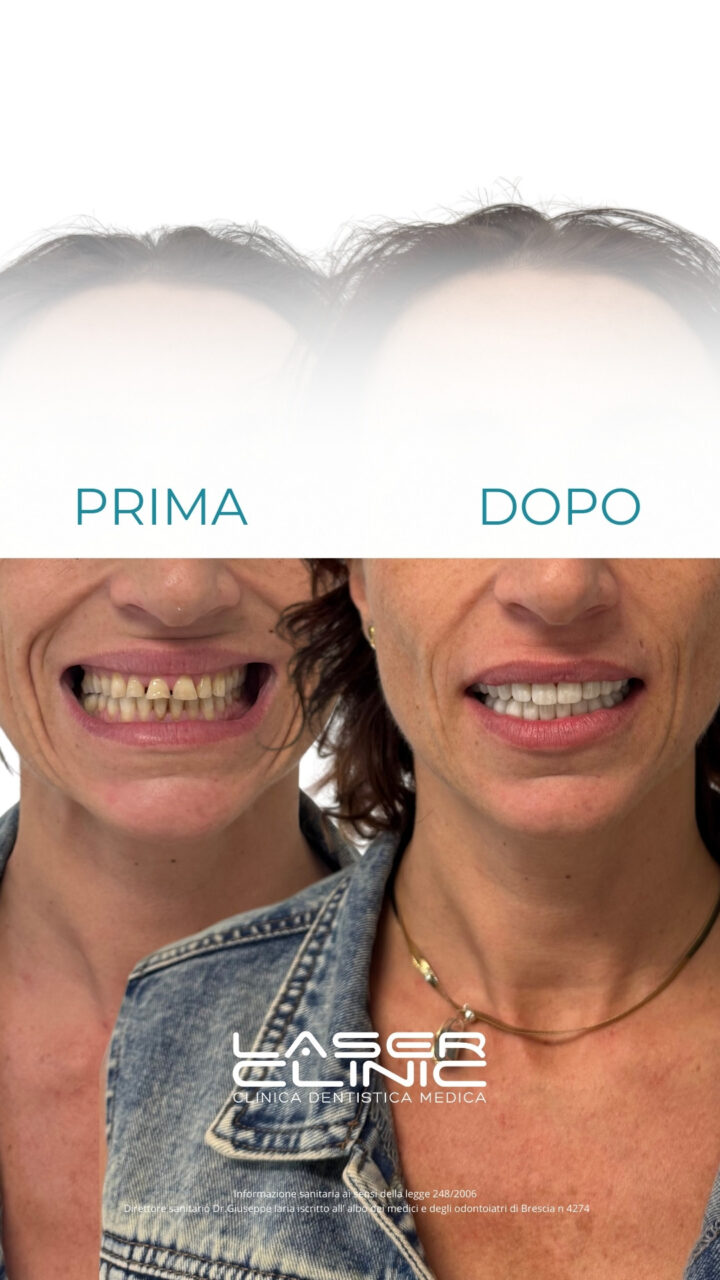 corone estetiche per risolvere problemi di erosione dentale - Faccette e Corone estetiche