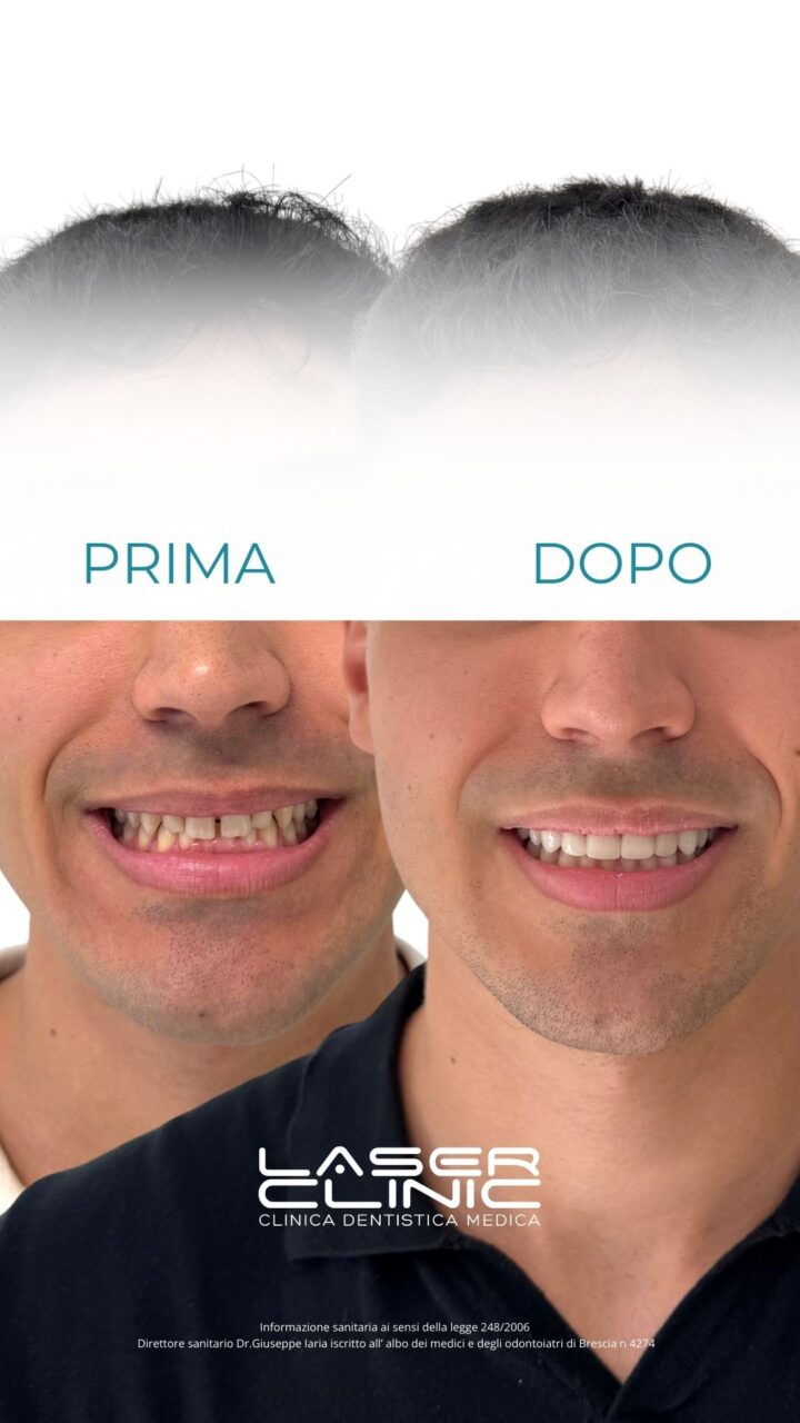 sei faccette in ceramica integrale - Faccette e Corone estetiche