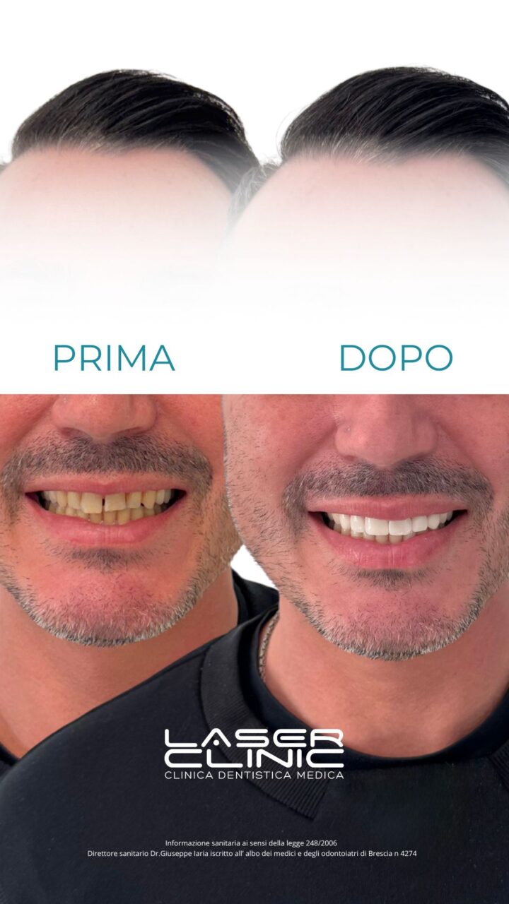  - Faccette e Corone estetiche