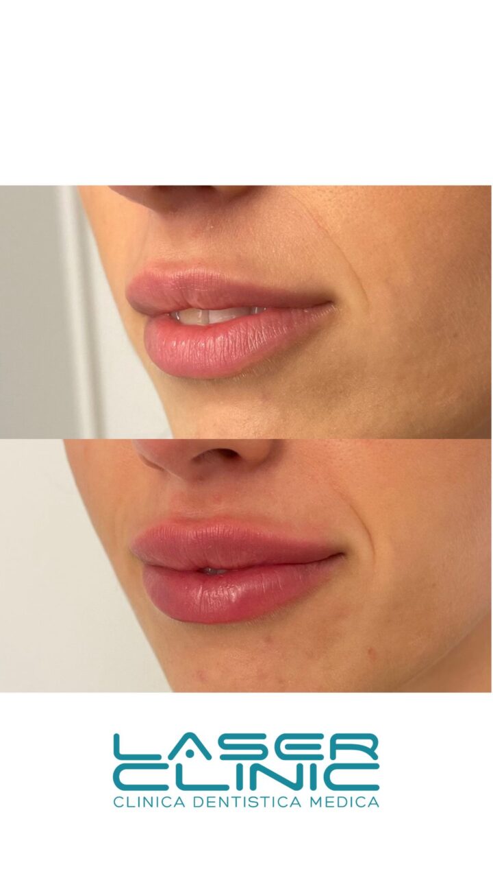  - Filler Estestici
